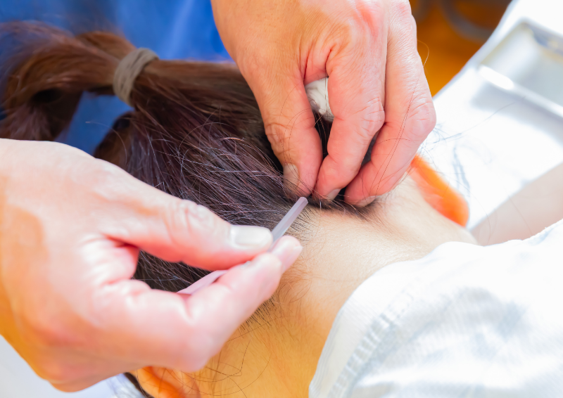 鍼灸施術を行う様子